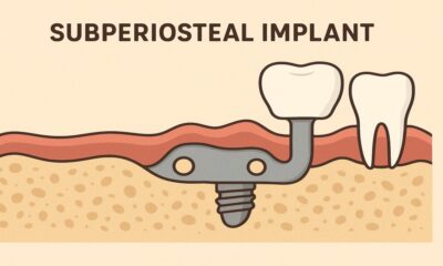 Subperiosteal Implant