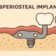 Subperiosteal Implant