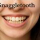 Snaggle Tooth