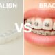 Invisalign vs Braces