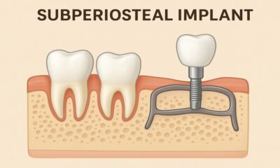 Subperiosteal Implant