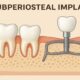 Subperiosteal Implant
