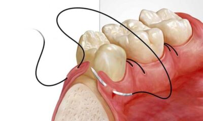 Alveoplasty