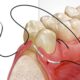 Alveoplasty