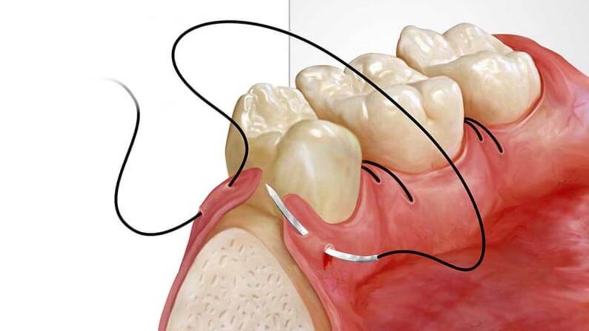 Alveoplasty