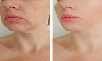 Microneedling Before and After