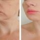 Microneedling Before and After