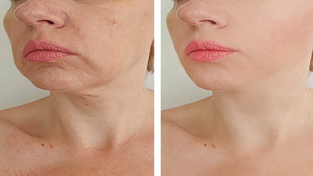 Microneedling Before and After